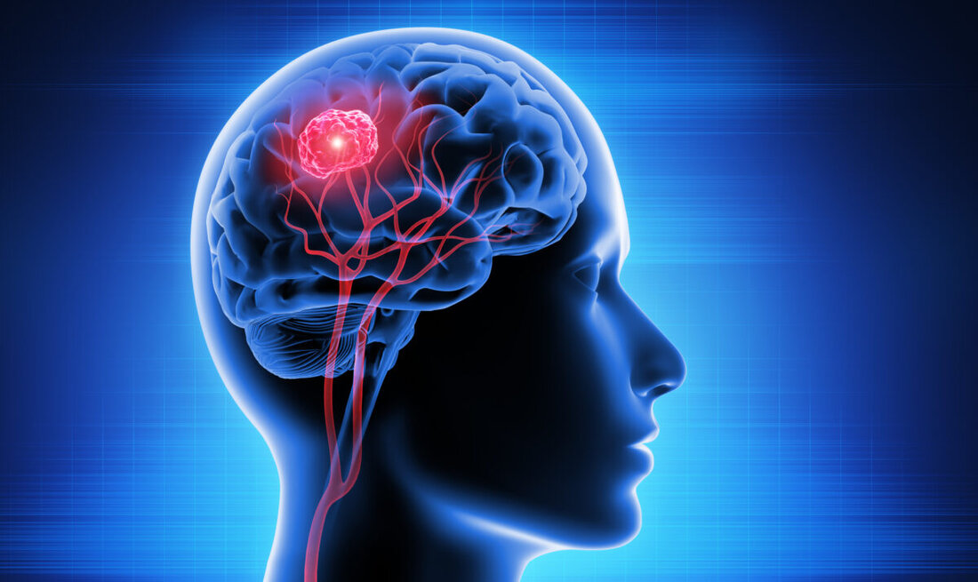 Weiden. Am Mittwoch, 10. Juli, erklärt PD Dr. Thomas Reithmeier in der vhs Weiden-Neustadt ab 18 Uhr, wie Hirntumore heute dank moderner Neurochirurgie sicherer entfernt werden. Veranstalter: Kliniken Nordoberpfalz, vhs.